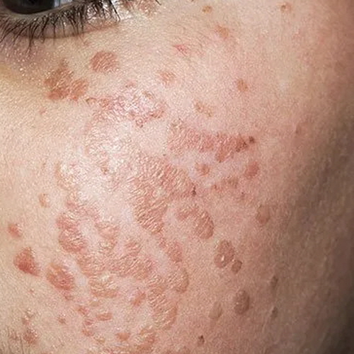 편평사마귀 치료 완벽 가이드 : 빠르고 안전한 제거 방법 2 verruca plana 1